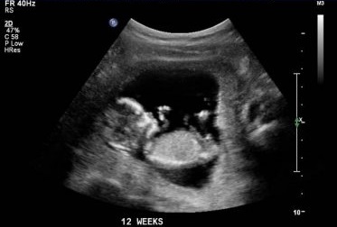 Ultrazvukový snímek plodu - 12. týden